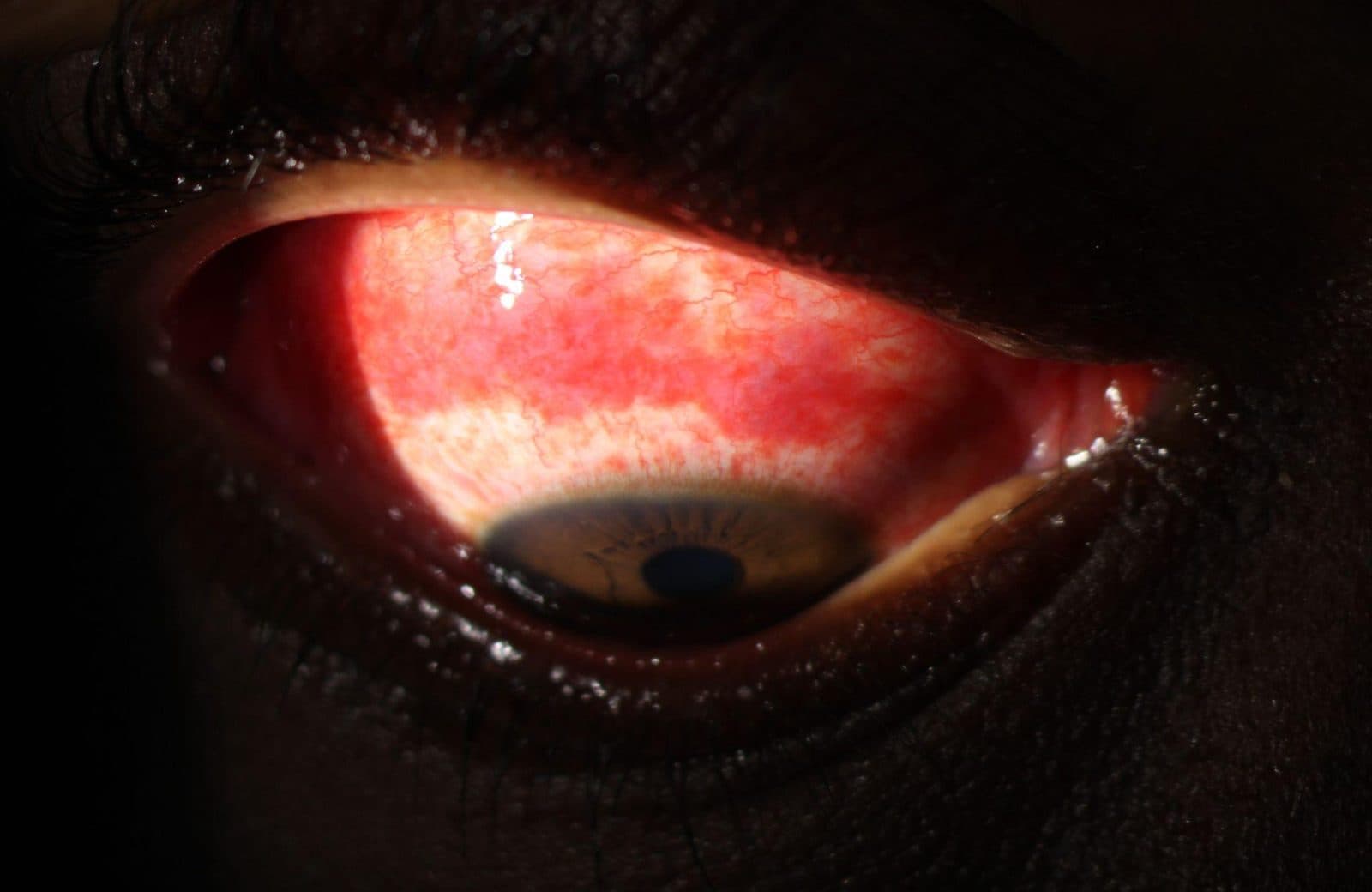 Acute haemorrhagic conjunctivitis