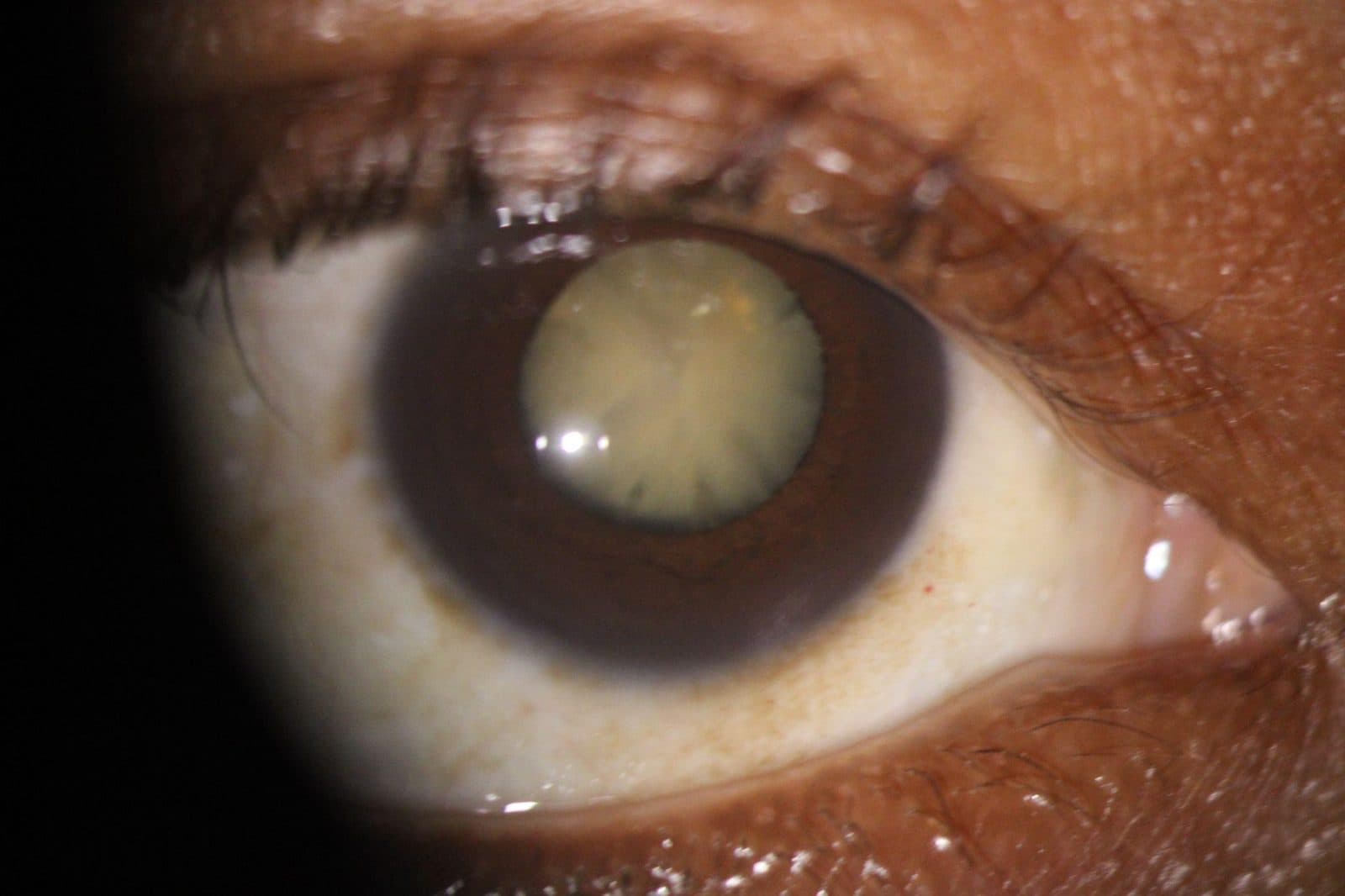 Cataract