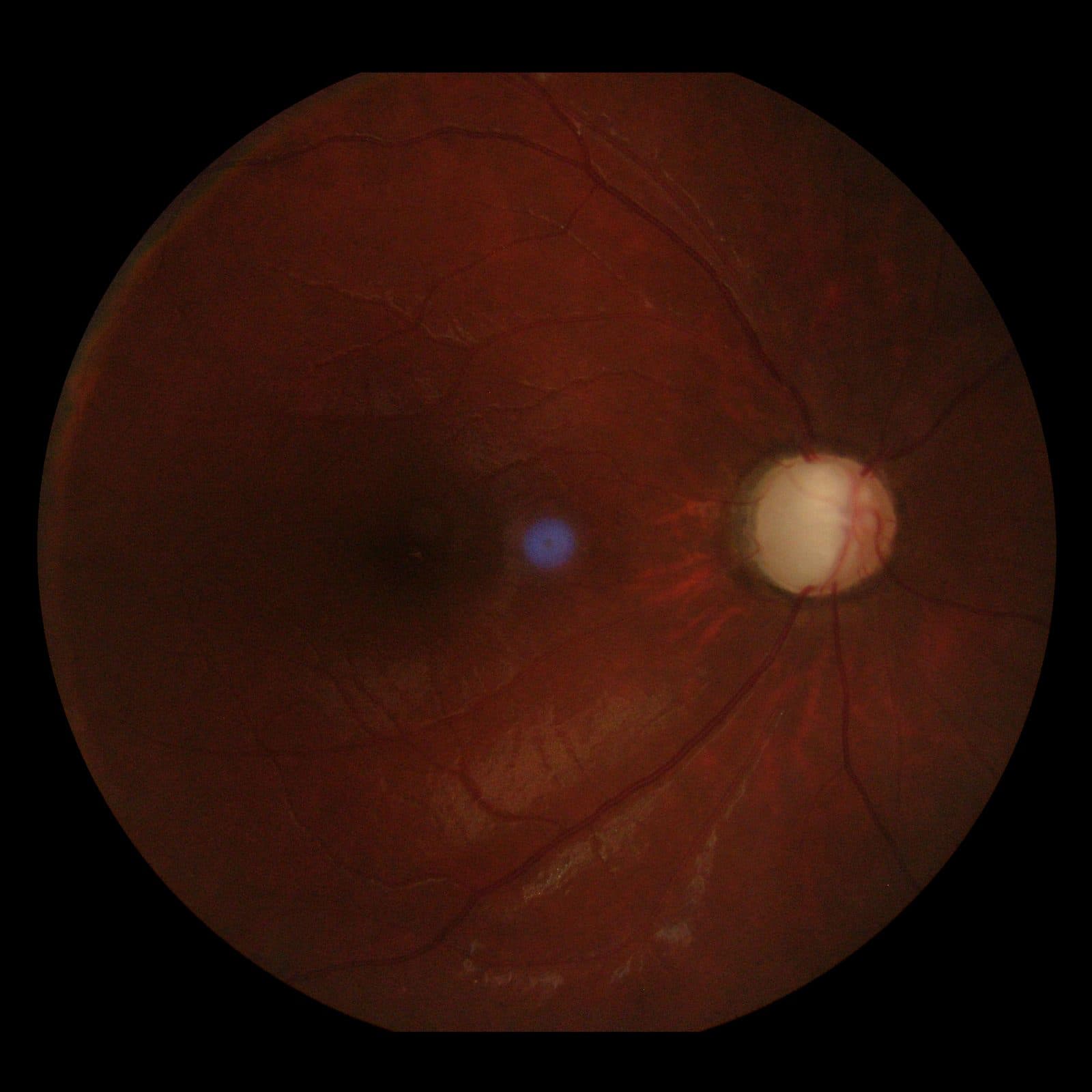 Optic disc cupping in glaucoma