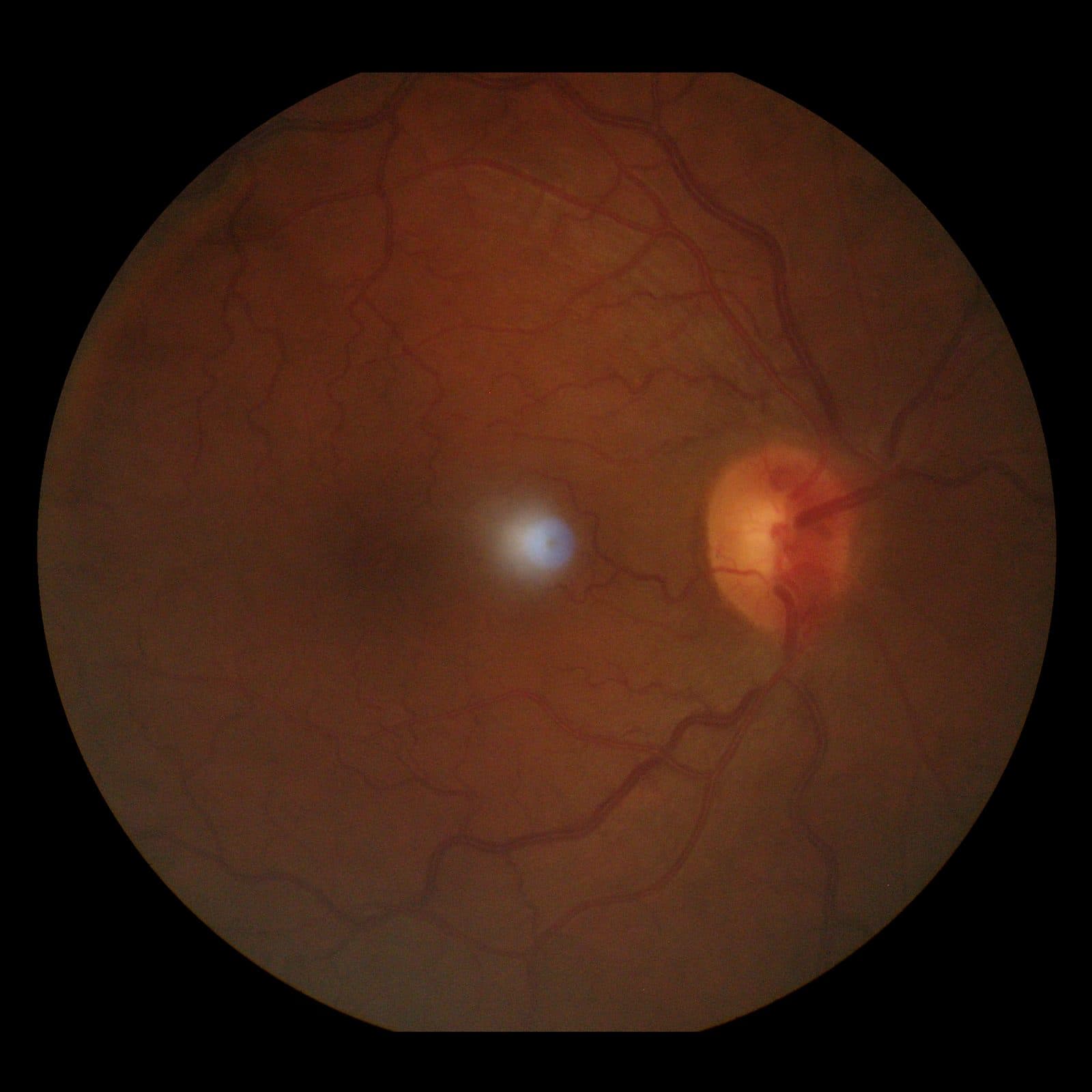 Hypertensive retinopathy
