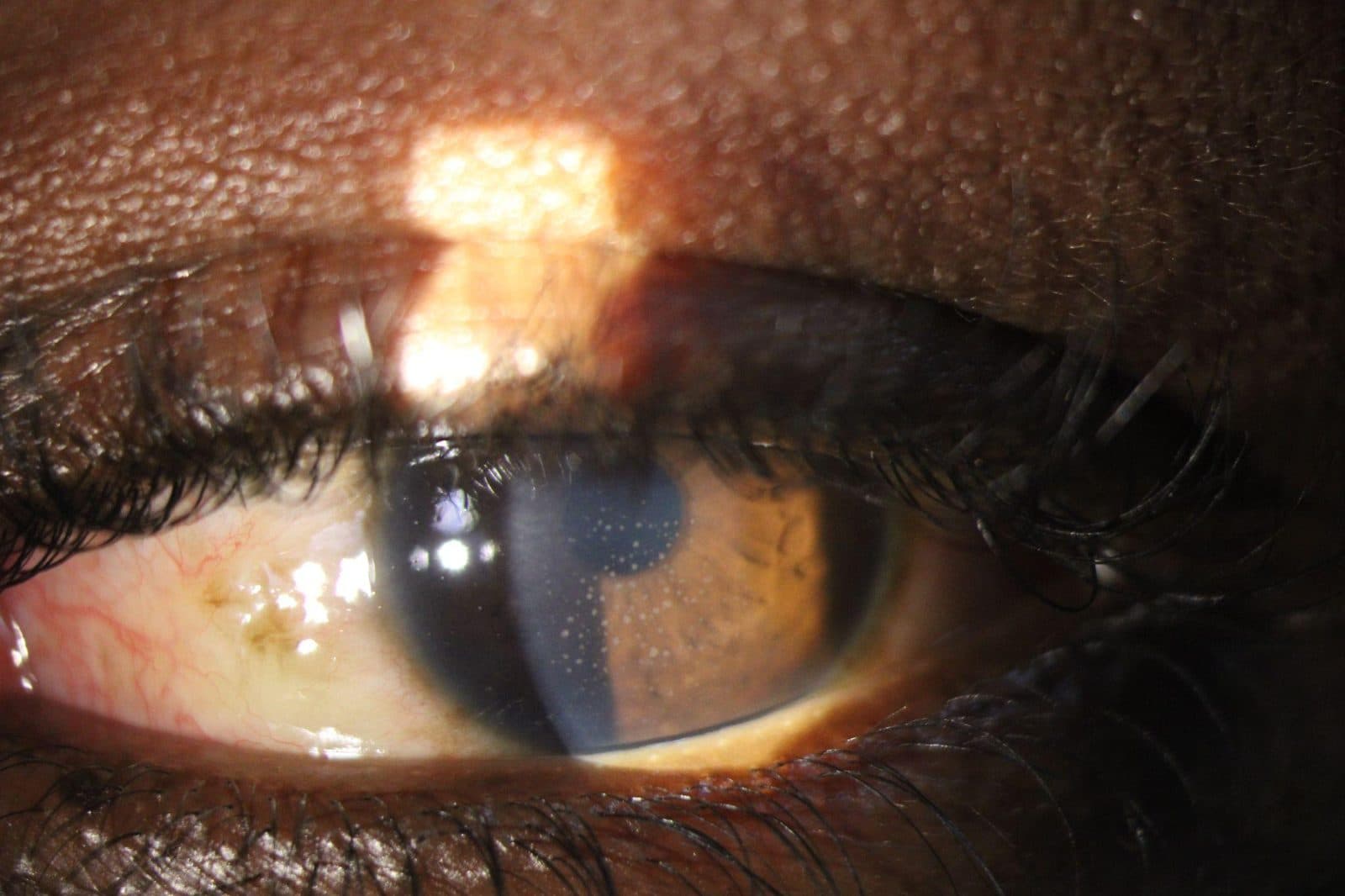Keratic precipitates in anterior uveitis