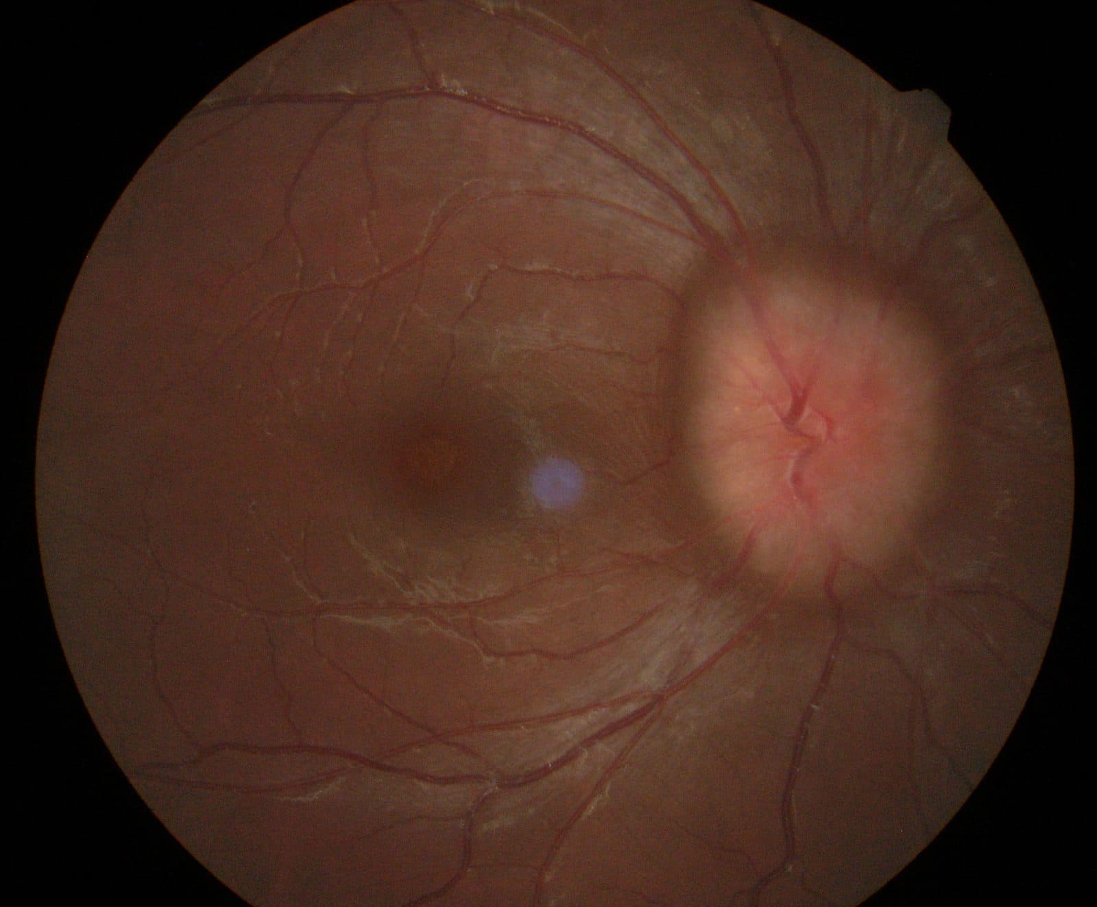 Papilloedema