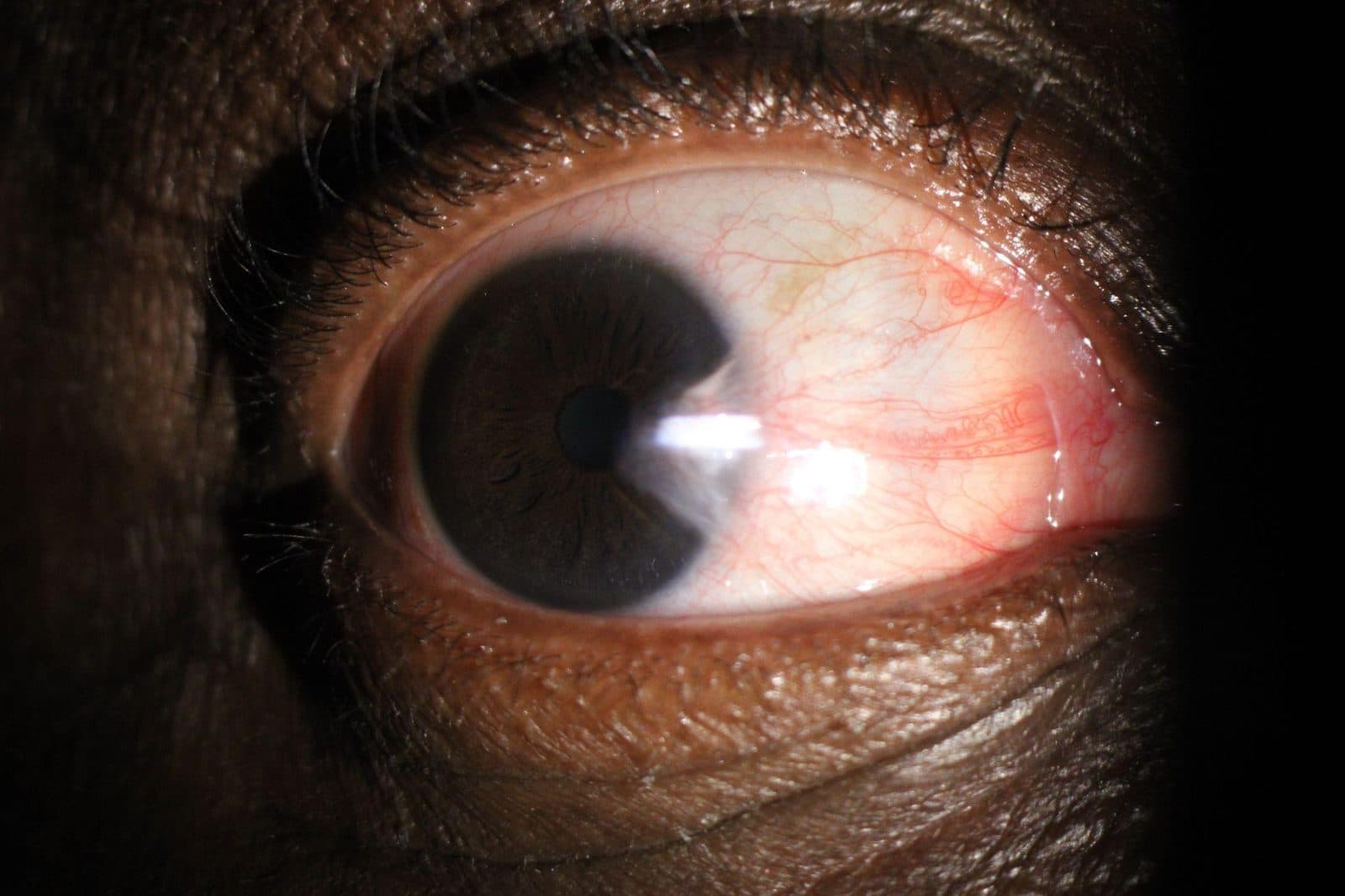 Pterygium