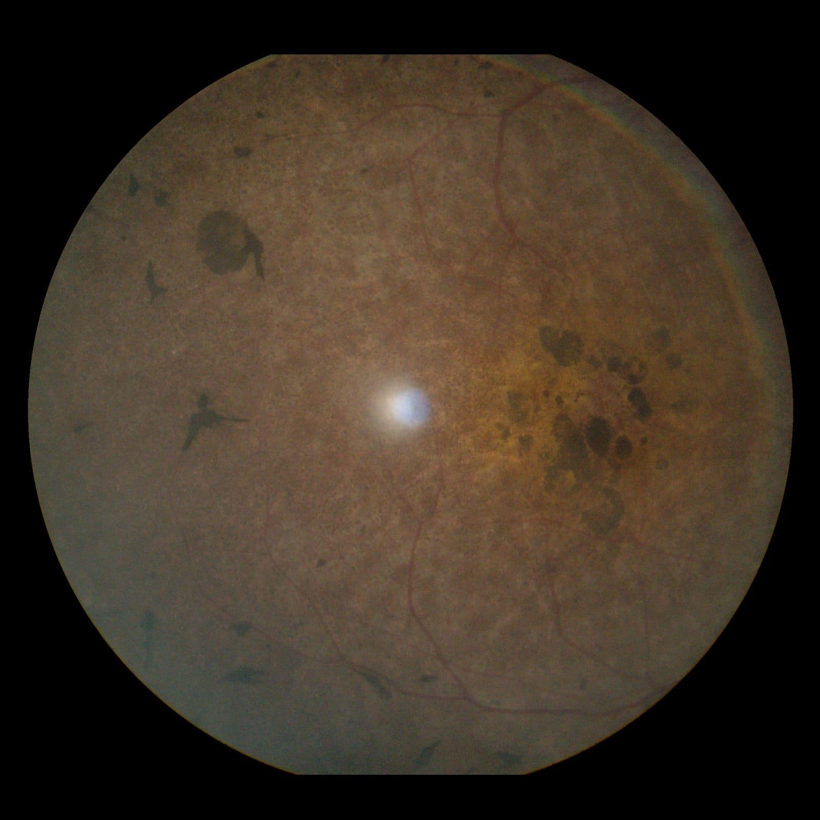 Retinitis pigmentosa