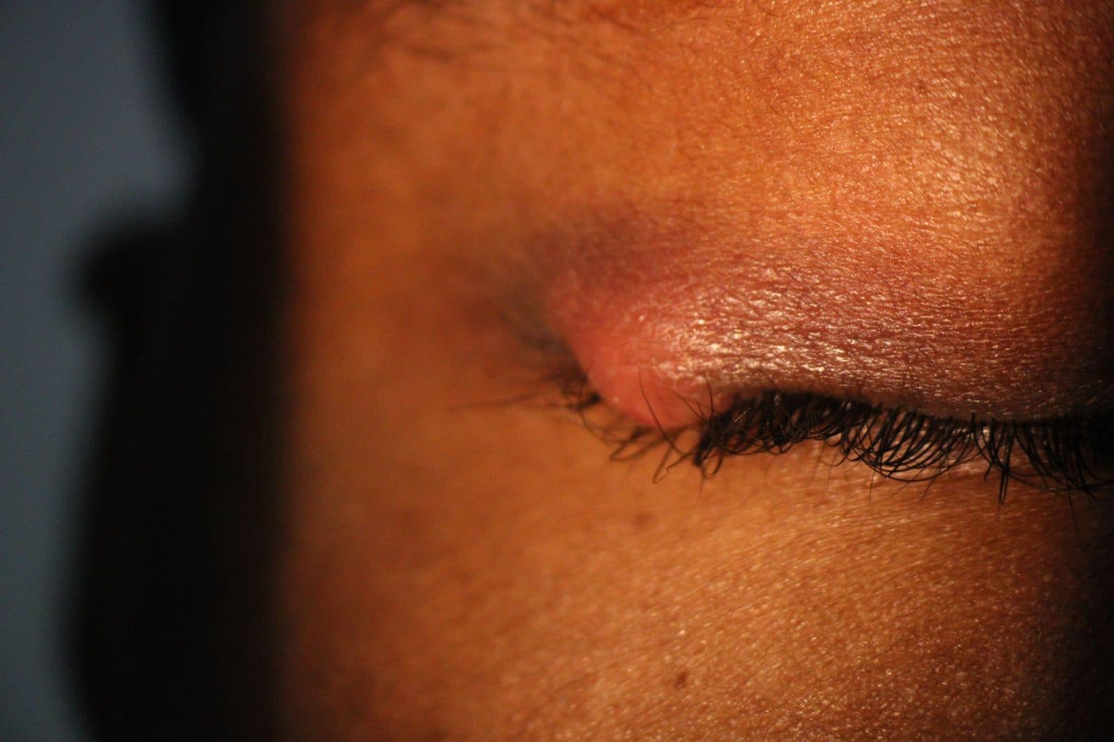 Stye (external hordeolum)