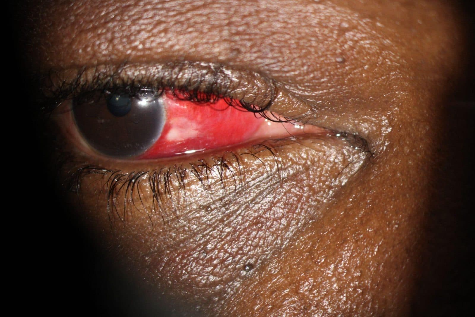 Subconjunctival haemorrhage