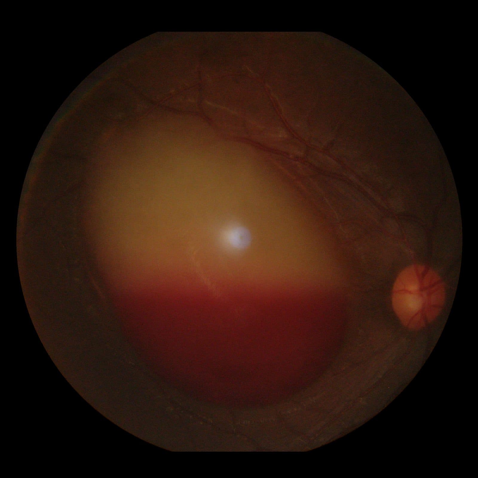 Valsalva retinopathy